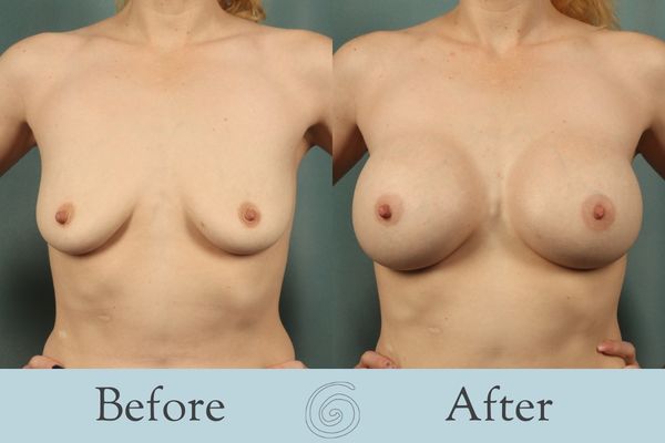 Breast Augmentation Before and After 28 - Front