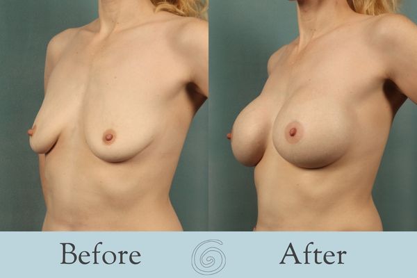 Breast Augmentation Before and After 28 - Side