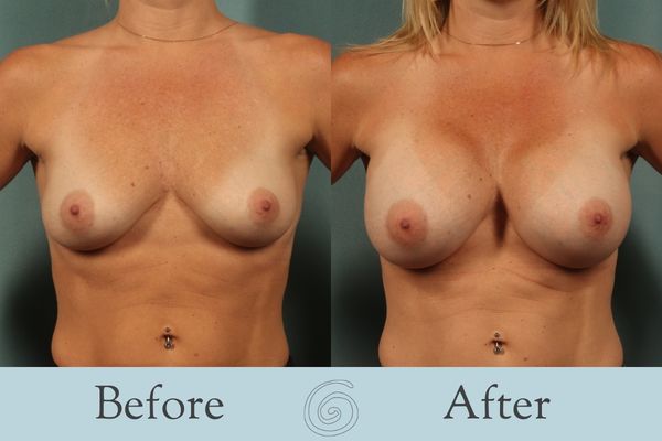 Breast Augmentation Before and After 29 - Front