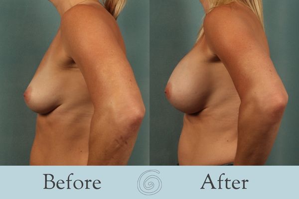 Breast Augmentation Before and After 29 - Side