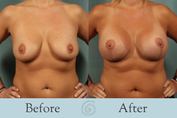 Breast Augmentation and Lift Before and After 16 _ Front
