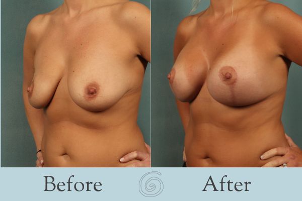 Breast Augmentation and Lift Before and After 16 _ Side
