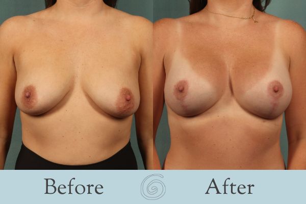 Breast Augmentation and Lift Before and After 17 _ Front