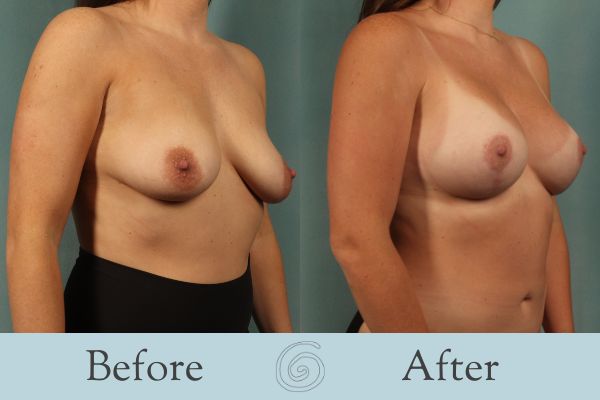 Breast Augmentation and Lift Before and After 17 _ Side