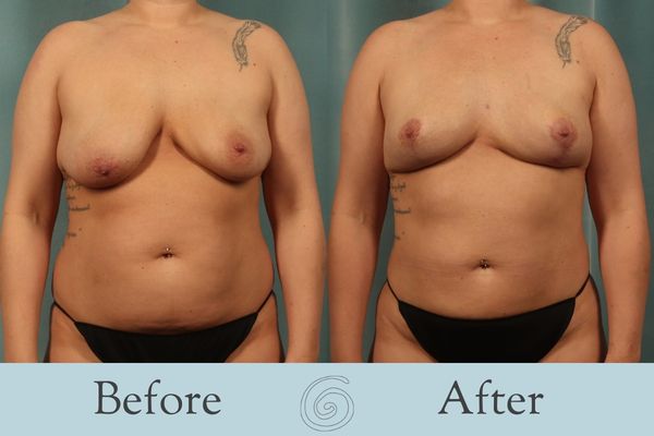 Breast Lift Before and After 6 - Front
