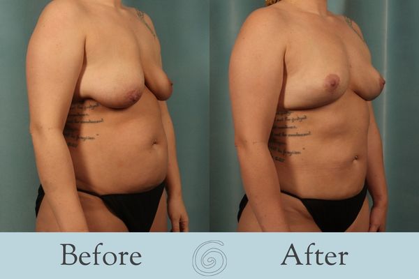 Breast Lift Before and After 6 - Side