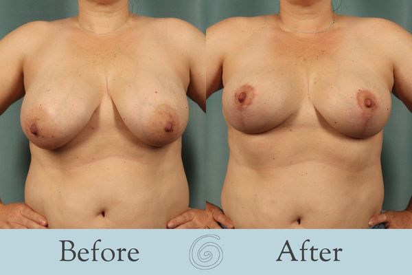 Breast Lift Before and After 7 - Front