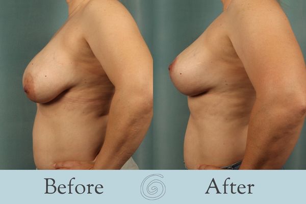 Breast Lift Before and After 7 - Side