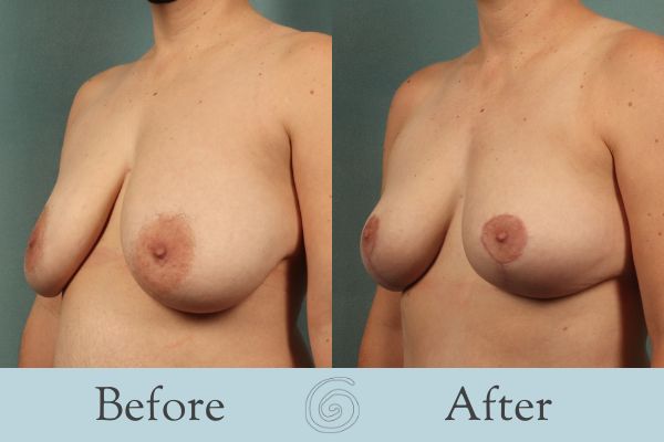Breast Lift Before and After 8 - Side