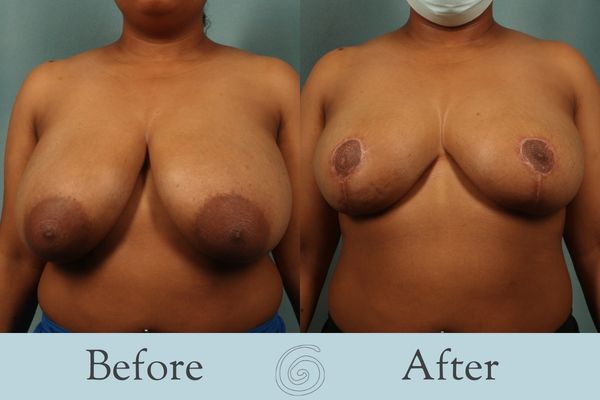 Breast Reduction Before and After 19 - Front