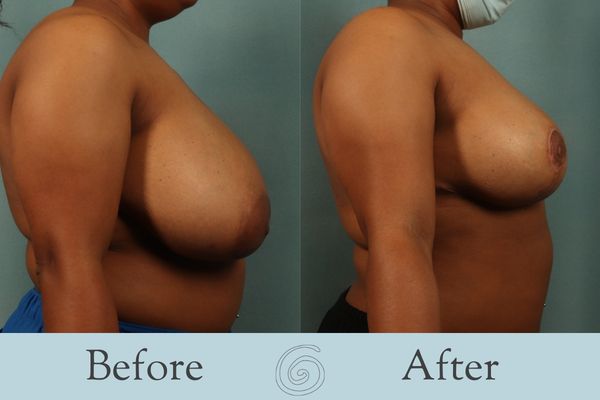 Breast Reduction Before and After 19 - Side