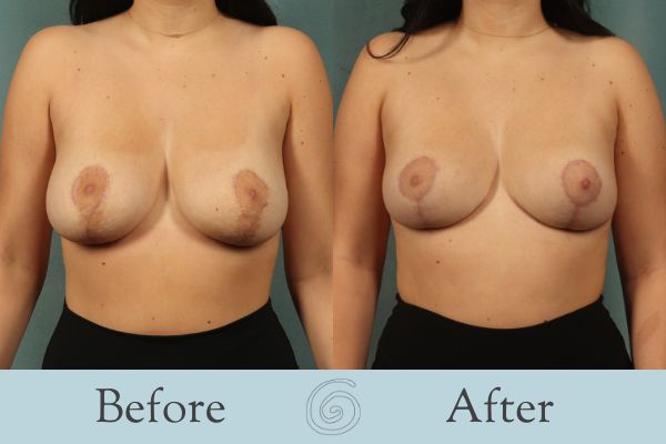 Breast Reduction Before and After 20 - Front