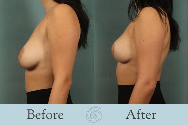 Breast Reduction Before and After 20 - Side