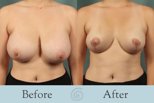 Breast Reduction Before and After 21 - Front
