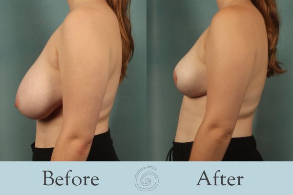Breast Reduction Before and After 21 - Side
