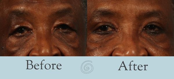 Eyelid Surgery Before and After 26 - Front