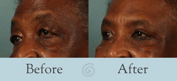 Eyelid Surgery Before and After 26 - Side