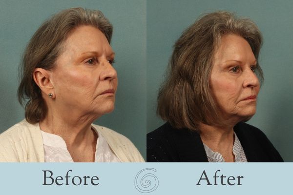 Facelift Before and After 11 - Side