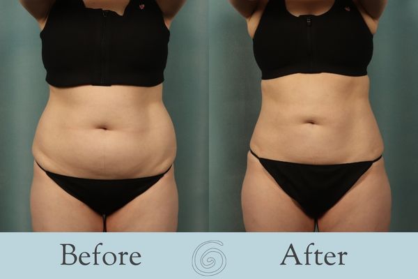 Liposuction Before and After 13 - Front