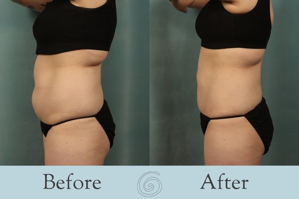 Liposuction Before and After 13 - Side