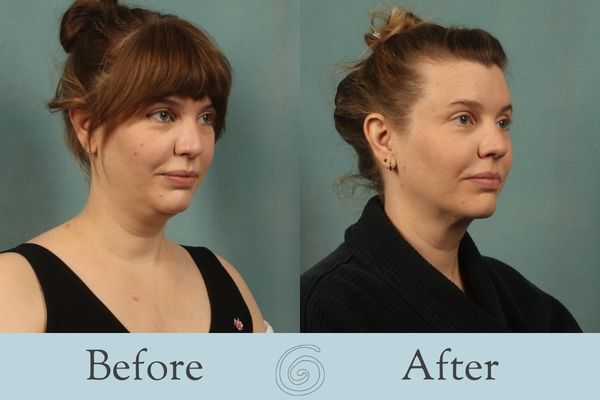 Liposuction Before and After 14 - Front