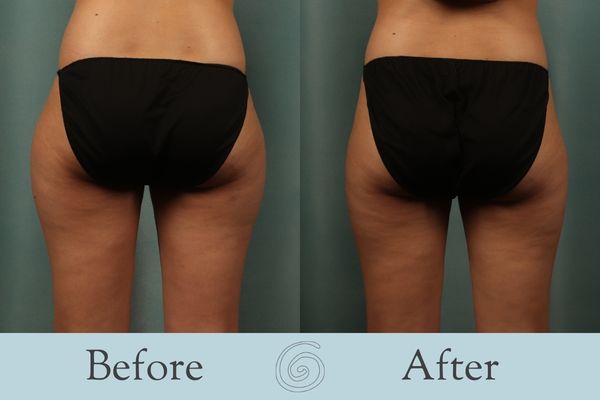 Liposuction Before and After 15 - Back