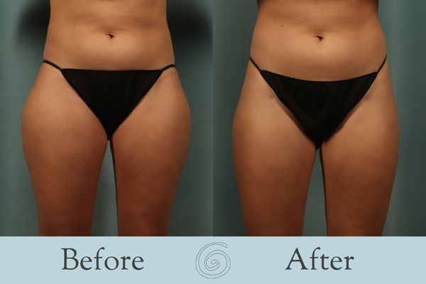 Liposuction Before and After 15 - Front