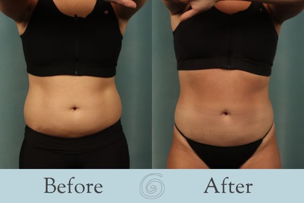 Liposuction Before and After 17 - Front