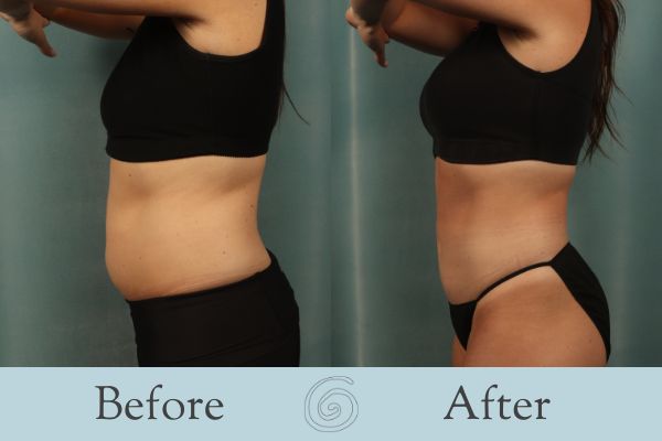 Liposuction Before and After 17 - Side