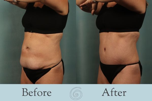 Tummy Tuck Before and After 26 - Side