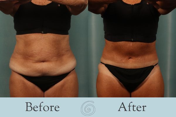 Tummy Tuck Before and After 27 - Front