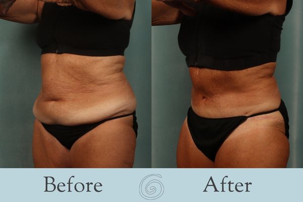 Tummy Tuck Before and After 27 - Side
