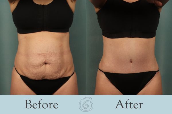 Tummy Tuck Before and After 28 - Front