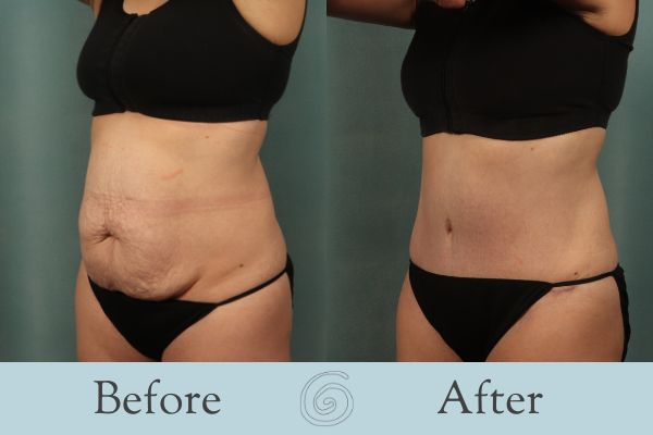 Tummy Tuck Before and After 28 - Side