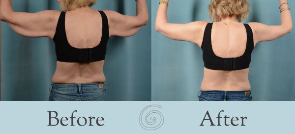 Upper Back Lift Before & After Gallery