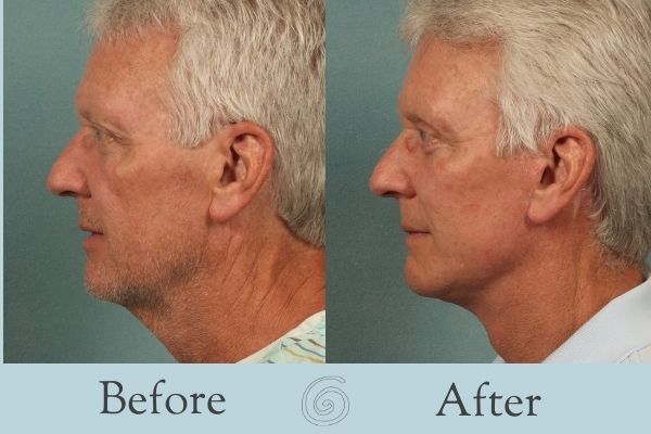 Facelift Before and After 10 - Side