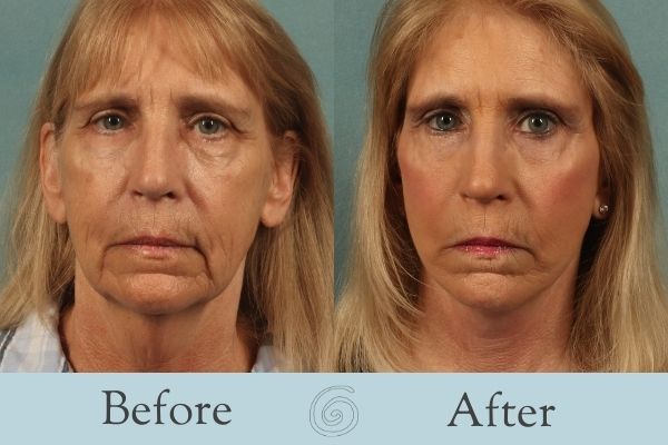 Facelift Before and After 9 - Front