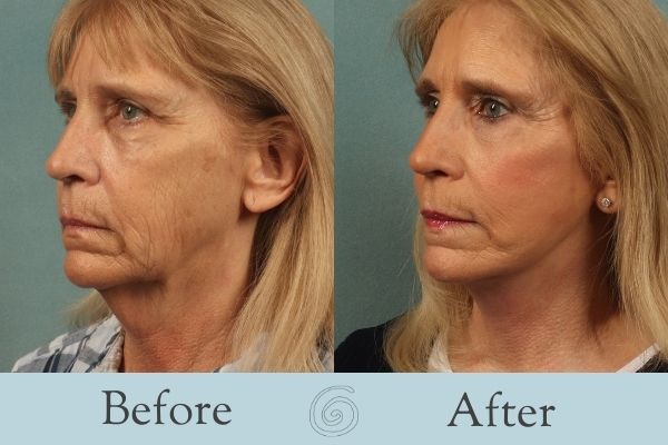 Facelift Before and After 9 - Side