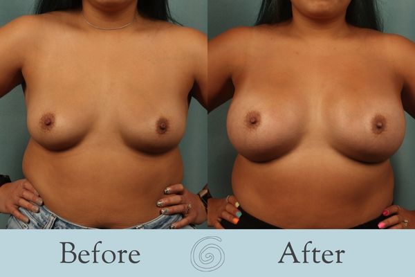 Breast Augmentation Before and After 30 - Front