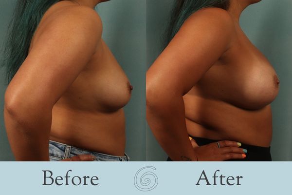 Breast Augmentation Before and After 30 - Side