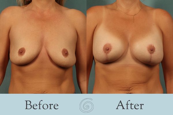 Breast Augmentation and Lift Before and After 18 _ Front