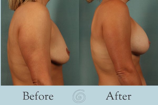 Breast Augmentation and Lift Before and After 18 _ Side