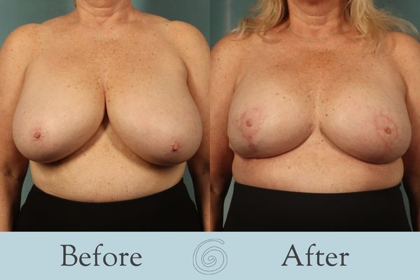 Breast Reduction Before and After 22 - Front