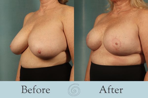 Breast Reduction Before and After 22 - Side