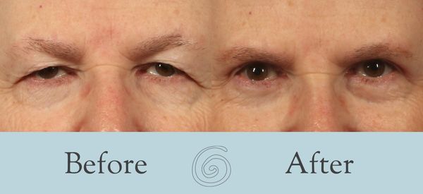 Eyelid Surgery Before and After 27 - Front