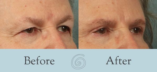 Eyelid Surgery Before and After 27 - Side