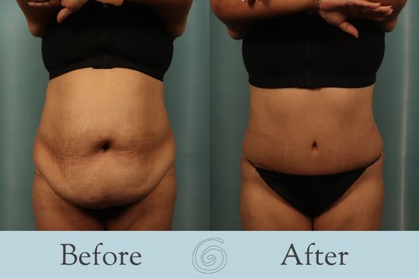 Tummy Tuck Before and After 29 - Front