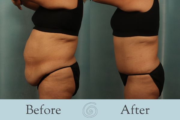 Tummy Tuck Before and After 29 - Side
