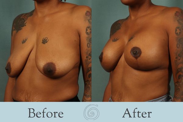 Breast Augmentation and Lift Before and After 19 _ Side