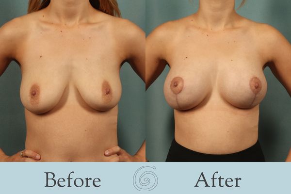 Breast Augmentation and Lift Before and After 20 _ Front